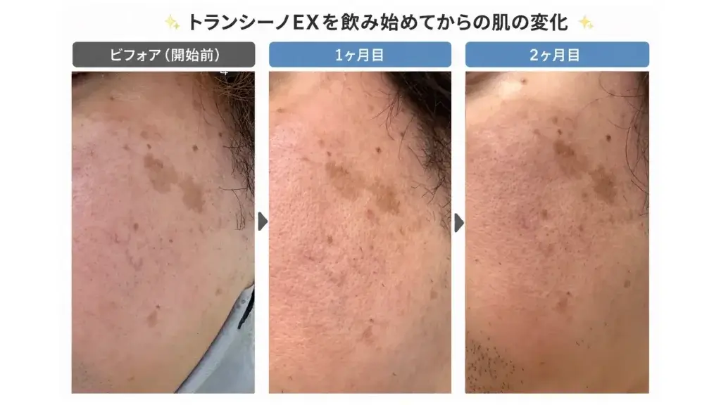 トランシーノEXを2か月間服用した際の肌の変化を、開始前・1か月後・2か月後で比較した実際の経過写真